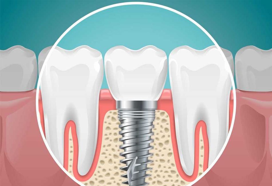 Dental-Implants