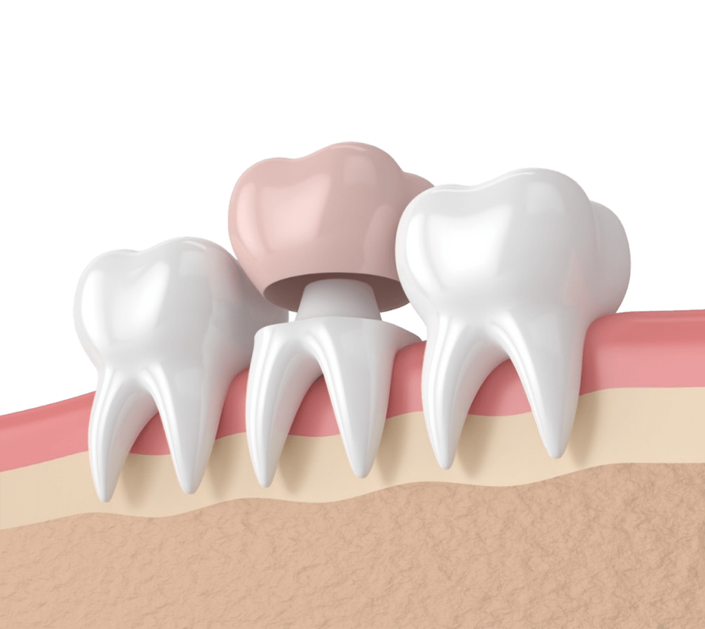 Dental Crowns & Bridges Services in Dwarka Apex Dental Clinic