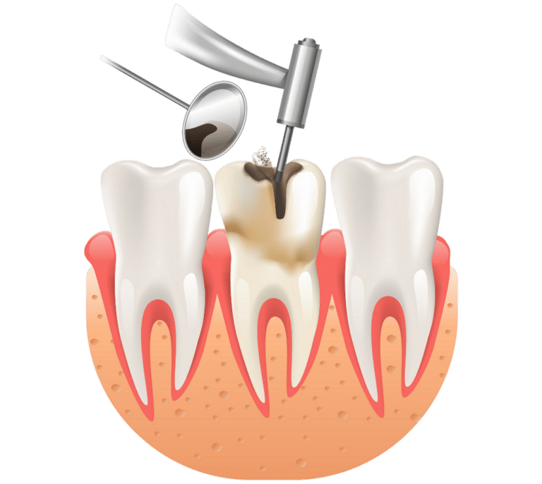 Root Canal Centre in Dwarka Best Root Canal Treatment in Dwarka